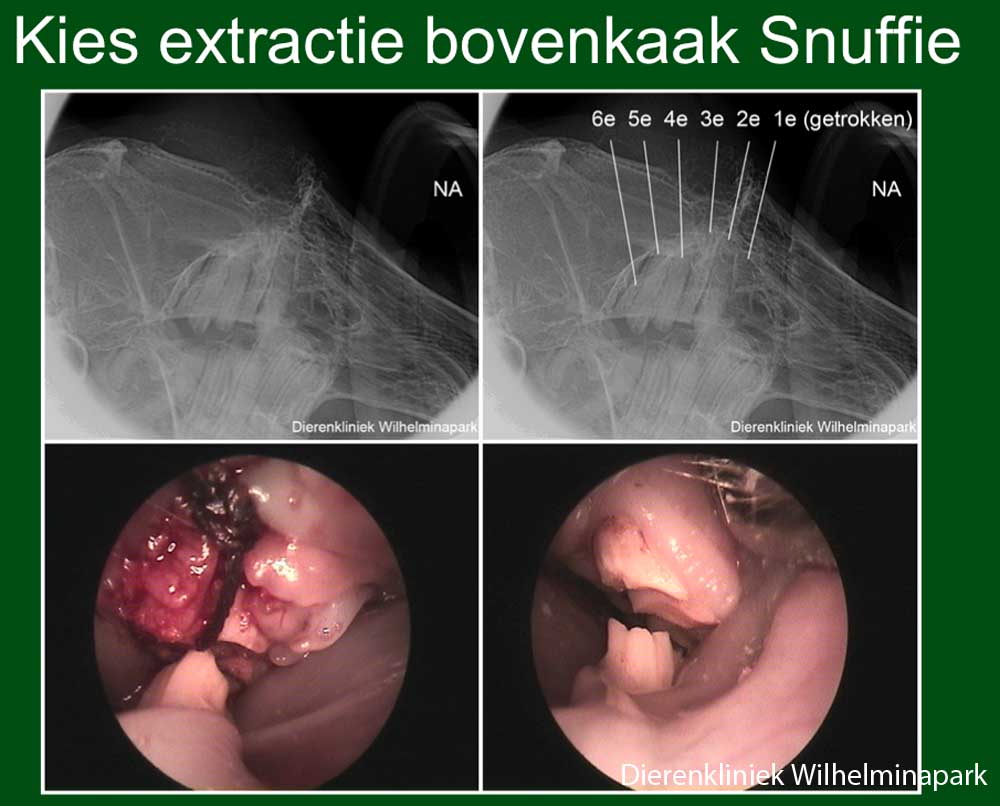 De 1e kies van de boven kaak aan de rechterkant wordt getrokken